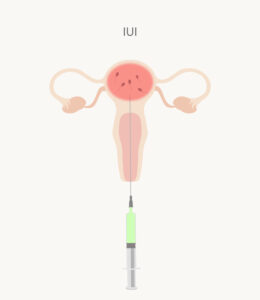 iui treatment in hyderabad