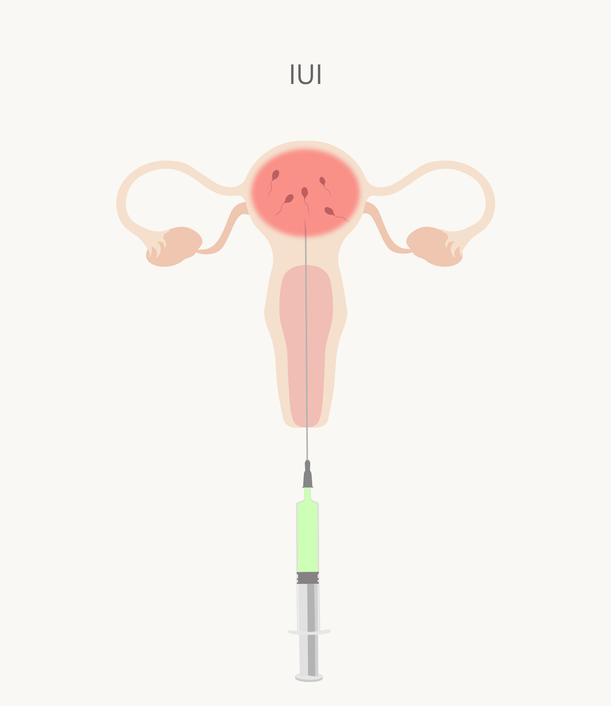 iui treatment in hyderabad